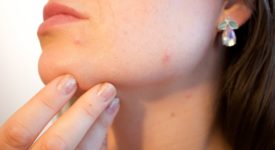Integratori omega 3 per combattere acne e impurità della pelle
