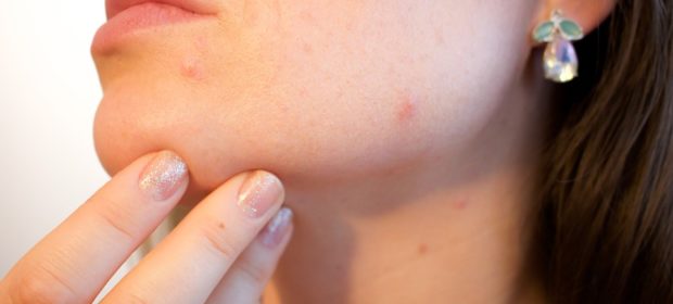 Integratori omega 3 per combattere acne e impurità della pelle