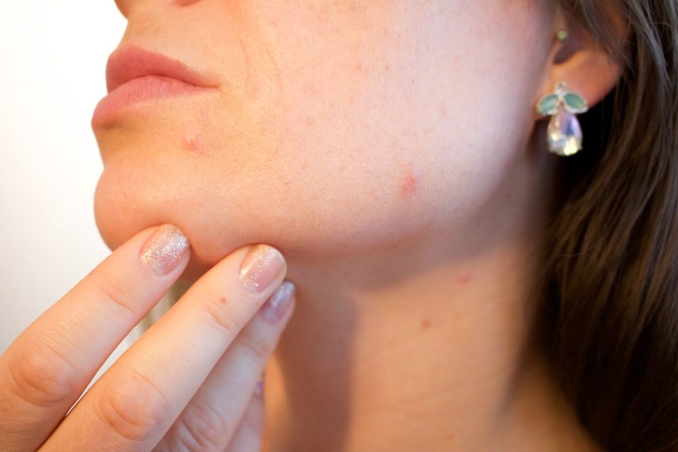 Integratori omega 3 per combattere acne e impurità della pelle